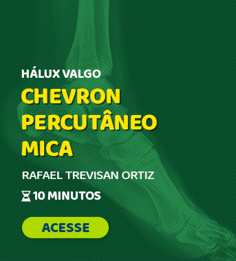 Percutânea 2023 - #05 - Chevron Percutâneo Mica (Hálux Valgo Moderado/Grave)